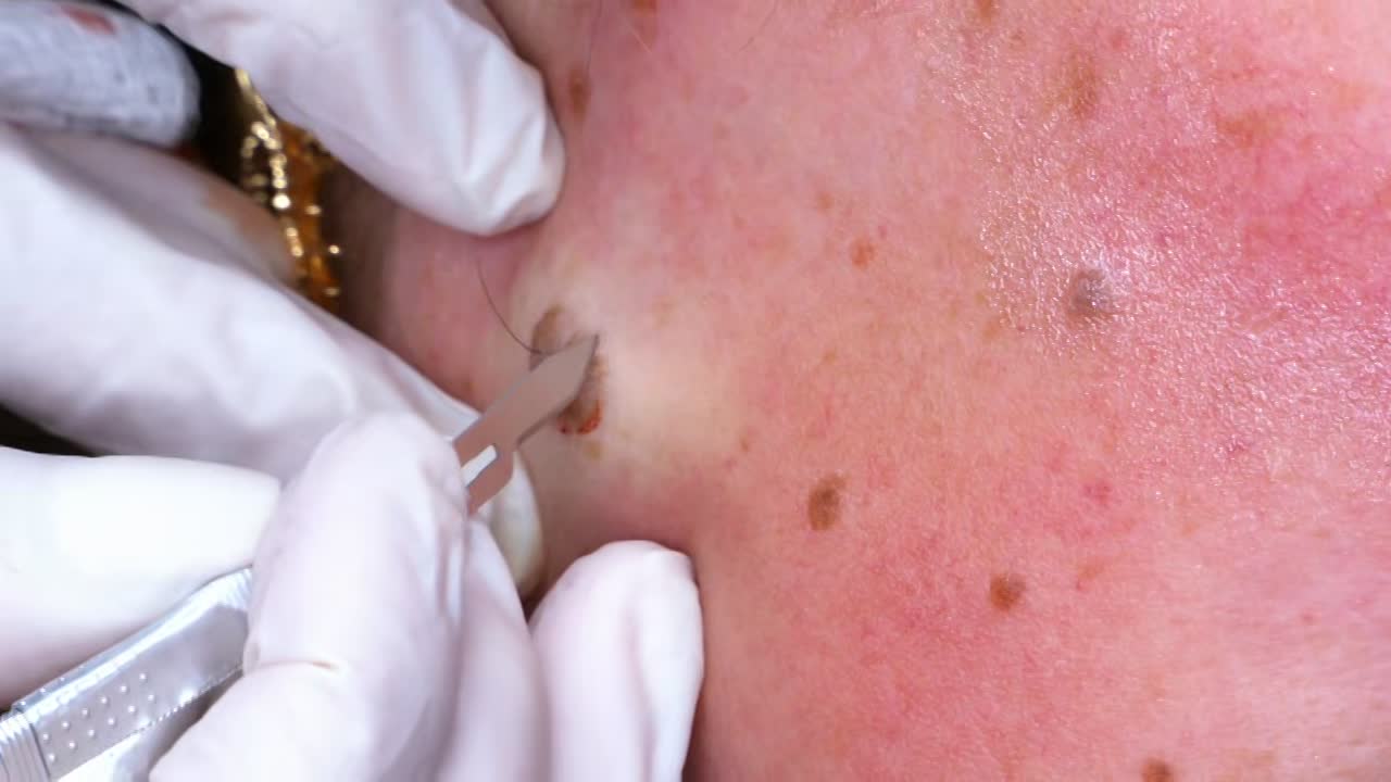 Dr. Pimple Popper Breaking Out S01E07