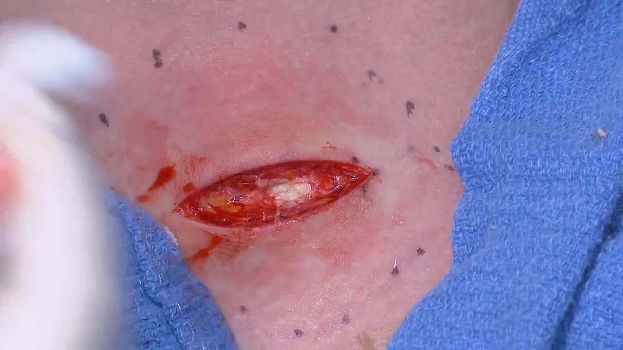 Dr. Pimple Popper Breaking Out S01E20